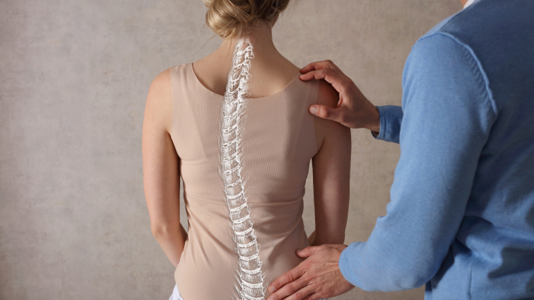 woman's spine with scoliosis who is seeking chiropractic care to reduce symptoms